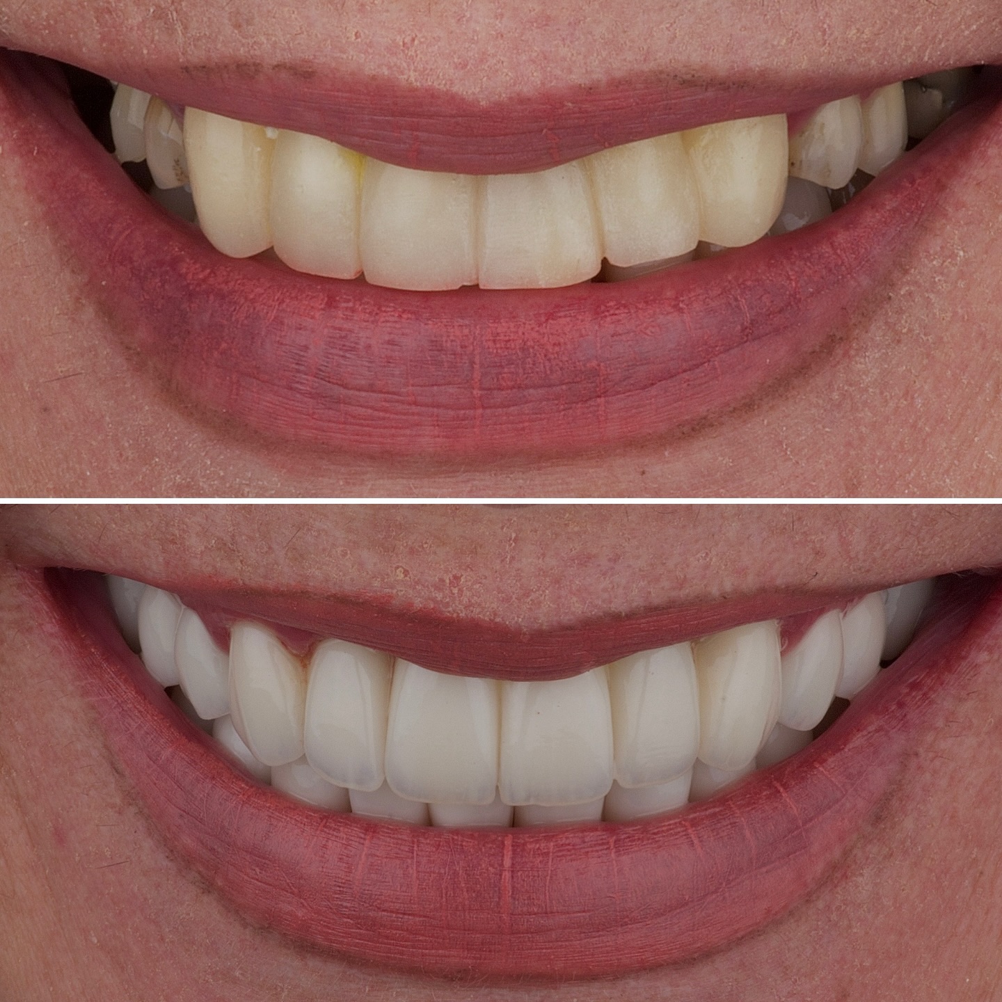 Diseño de sonrisa